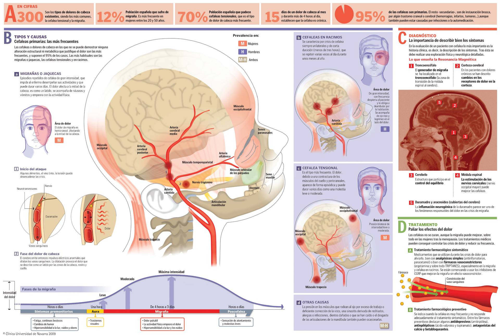 Infográfico Cefaleas Dolor de cabeza Clínica Universidad de Navarra