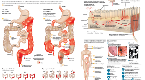 Enfermedad De Crohn ¿qué Es Síntomas Y Tratamiento Clínica Universidad De Navarra 0967