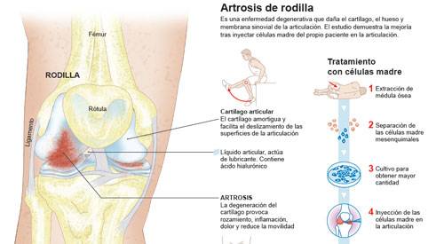 Artrosis de Rodilla – Trauma Advance