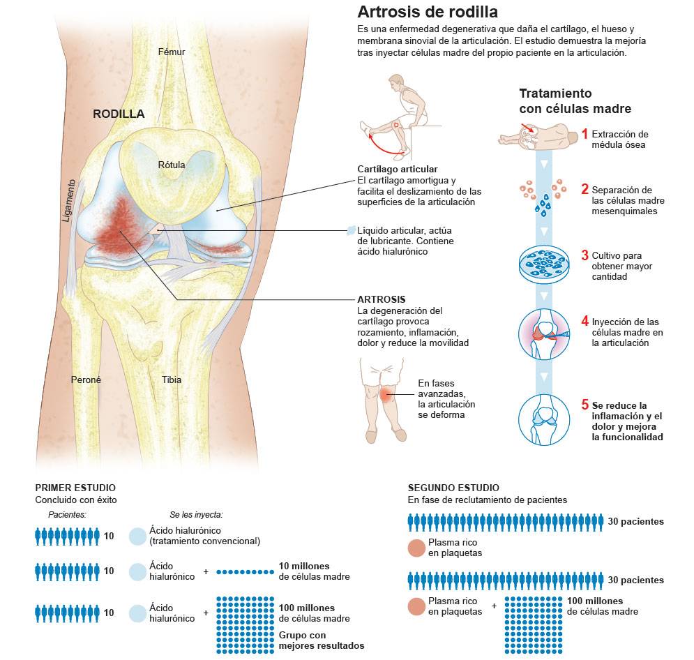 Artrosis de Rodilla: qué es, síntomas y tratamiento