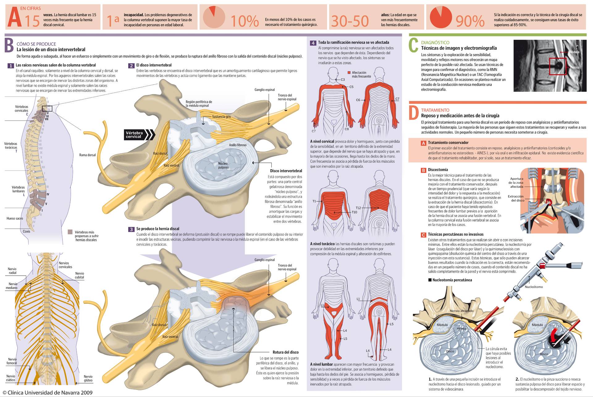 Lumbar Disc Herniation: what it is, symptoms and treatment. Clínica  Universidad de Navarra