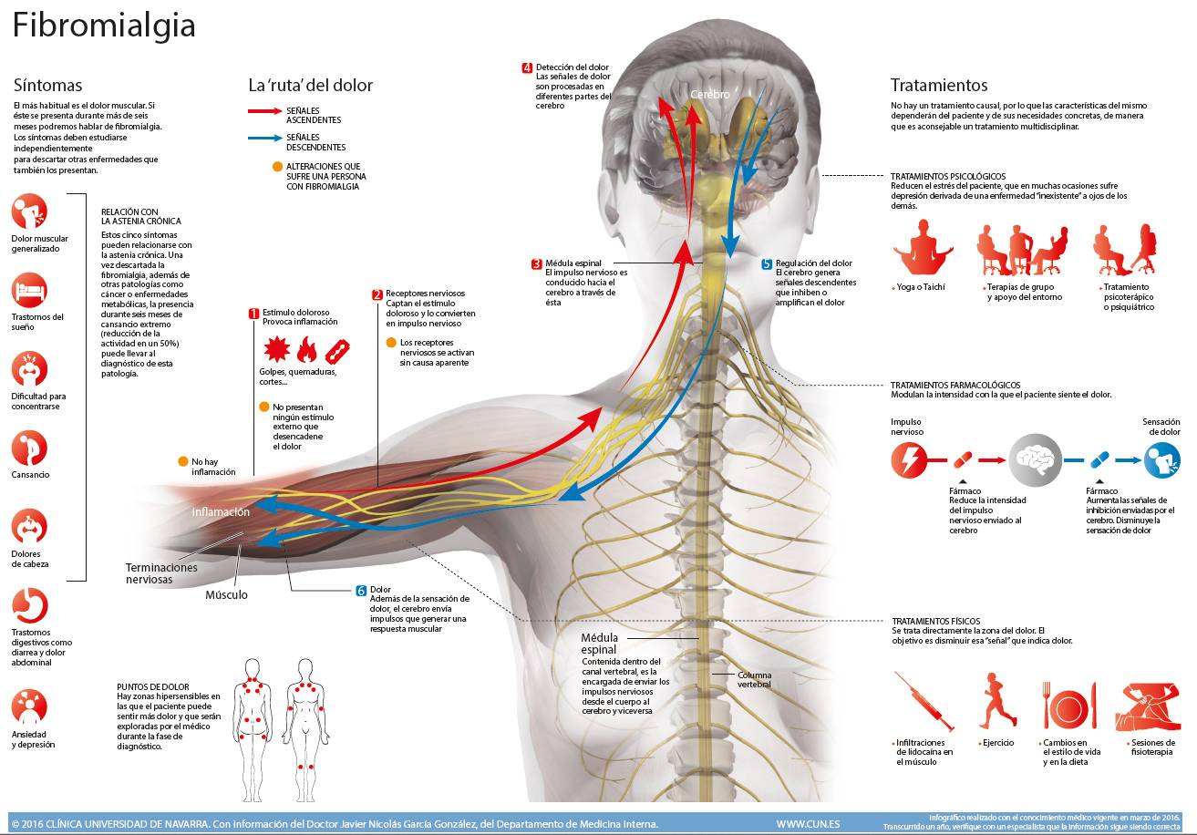 Fibromialgia: Síntomas, diagnóstico y tratamiento. Clínica Universidad ...