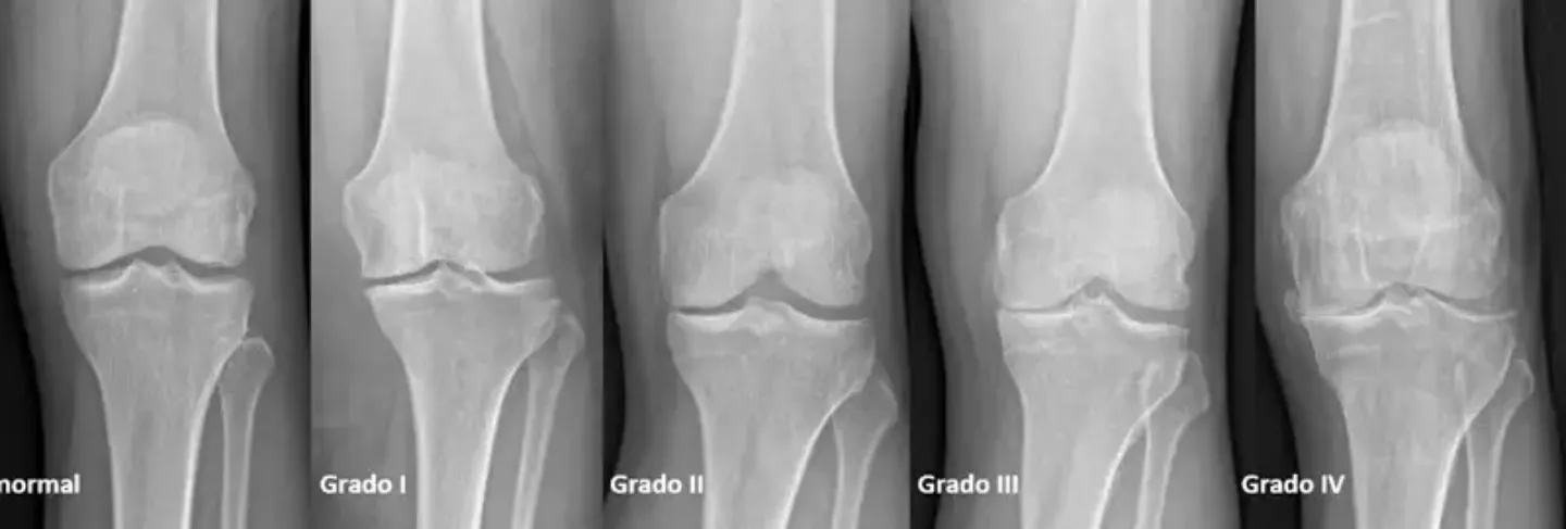 Los 4 Grados de Artrosis según valoración radiológica ✓
