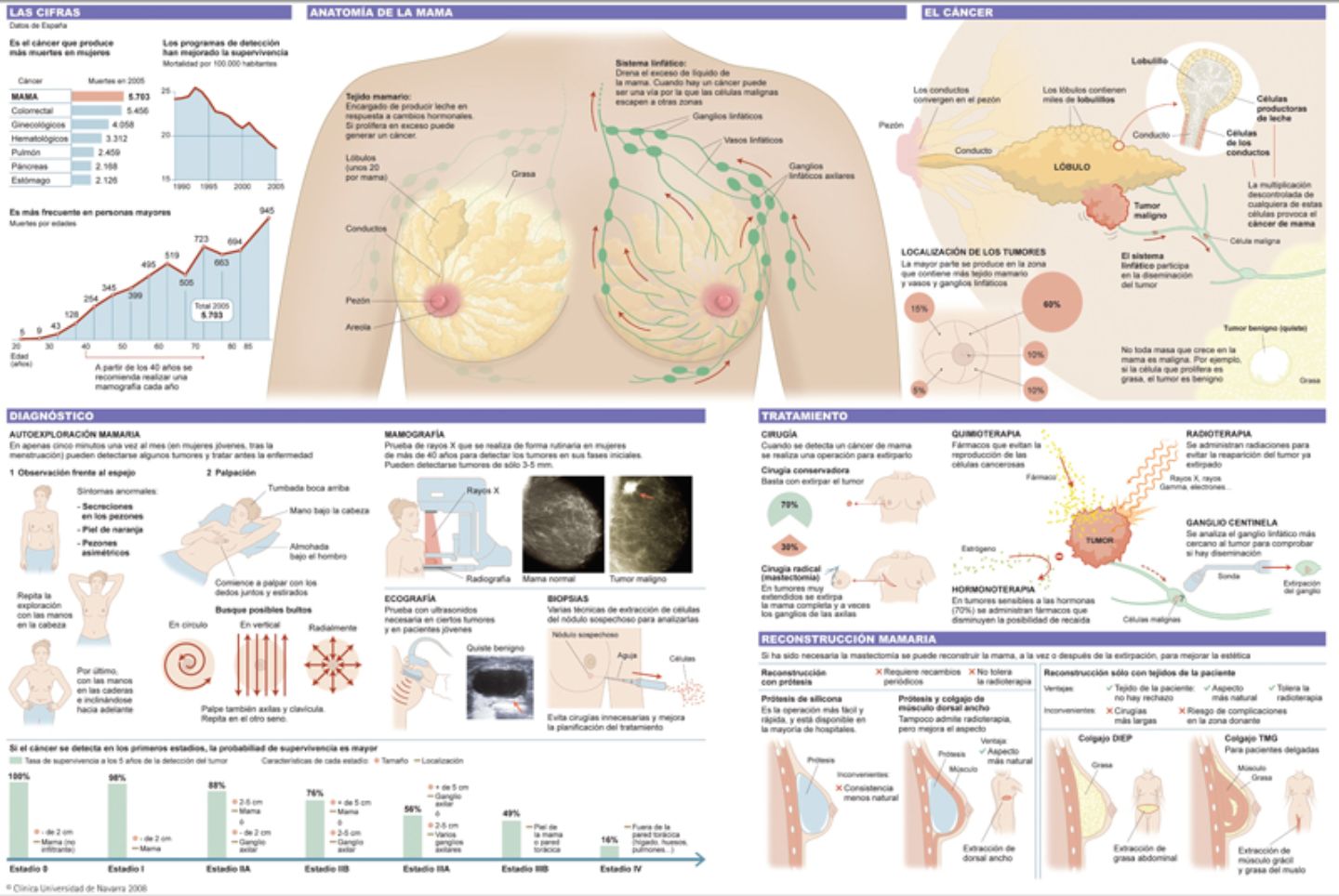 cancer de mama infografia