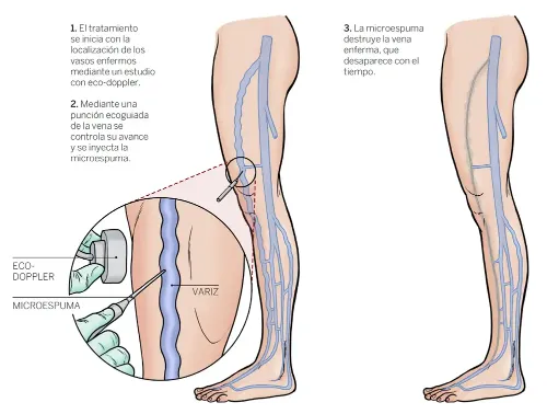 https://www.cun.es/.imaging/mte/newstyle/half/dam/cun/imagen/departamentos/cirugia-vascular/microespuma-varices/jcr:content/microespuma-varices.webp