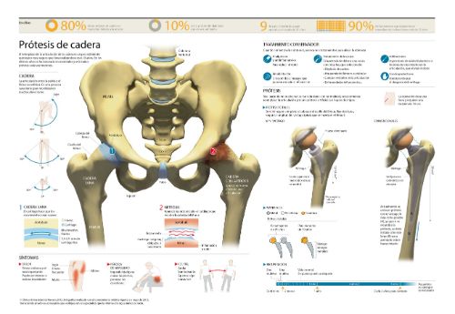2012-protesis-cadera-max <p>Infográfico sobre la prótesis de cadera, sustitución de la cadera en casos de artrosis y otras enfermedades degenerativas de la cadera. </p>