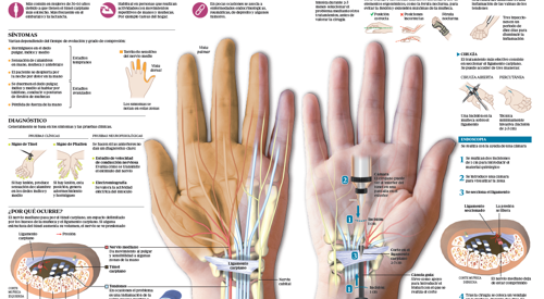 Artrosis de la mano y muñeca: síntomas y tratamiento. Clínica Universidad  de Navarra