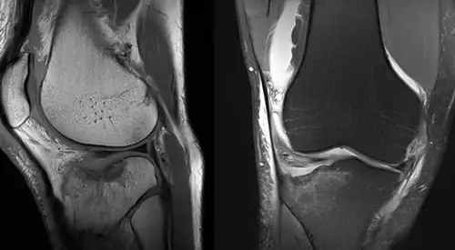 anatomía de la meseta tibial