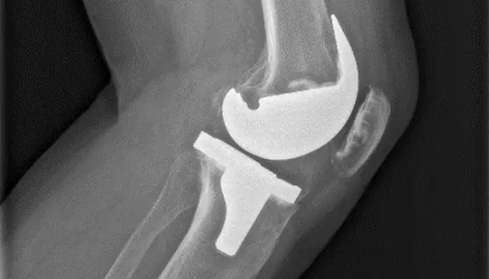 Artrosis de Rodilla: Causas, Síntomas y Tratamientos - Incar - Clínica Osten